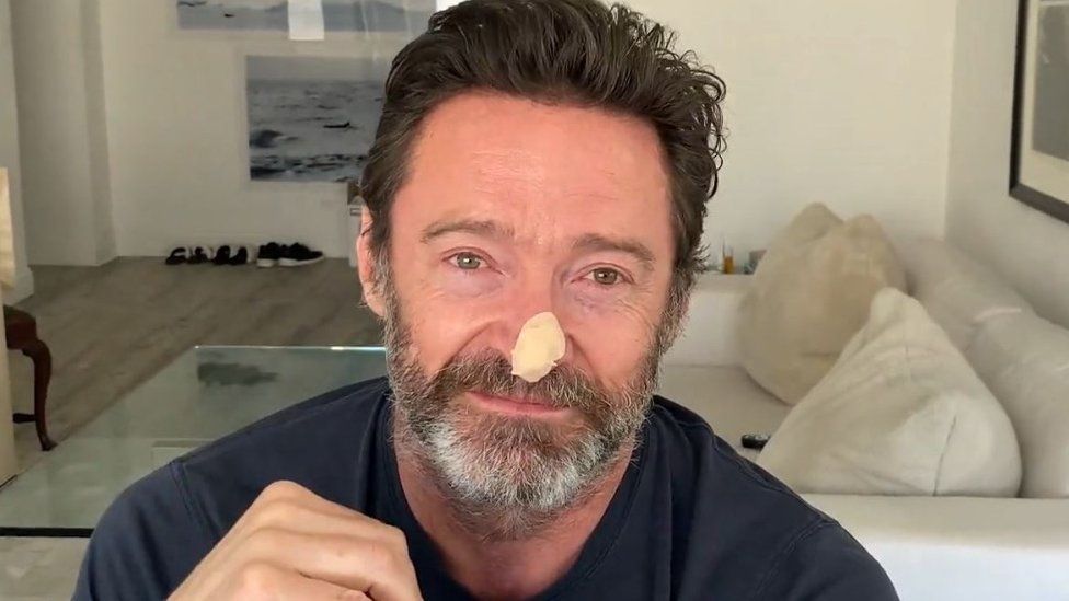 What is Basal Cell Carcinoma Hugh Jackman’s Curable Skin Cancer